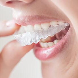 Athletic Mouthguards | Preventive Dentistry Fort Worth | Hulen Dental