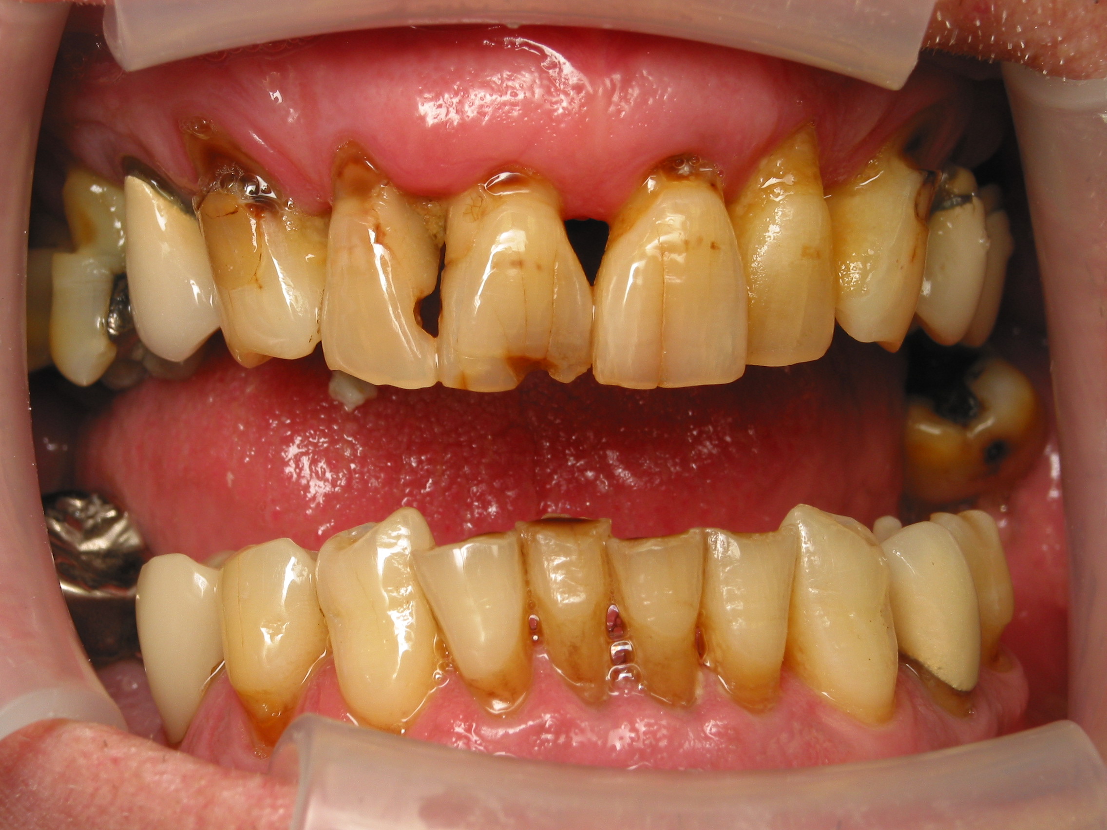 snap in dentures problems